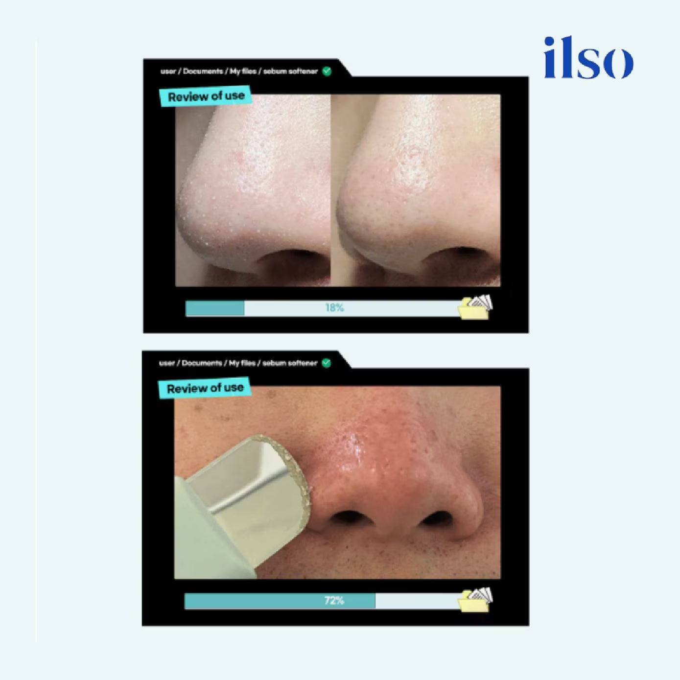 ilso Super Melting Sebum Softener 150ml Set +Cotton Pad 40P