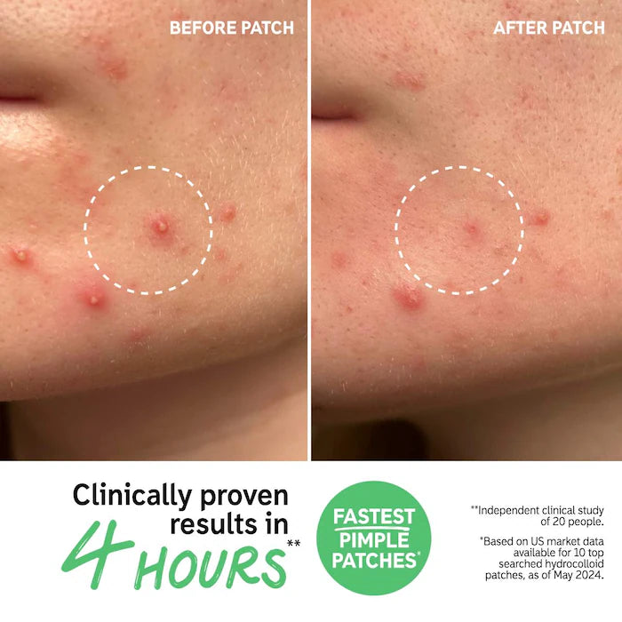 Hydrocolloid Invisible Pimple Patches + Salicylic Acid The Inkey List